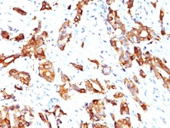 IHC: Formalin-fixed, paraffin-embedded human breast carcinoma stained with HSP27 antibody (clone HSP