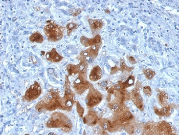 IHC staining of FFPE human hepatocellular carcinoma with SAA antibody. HIER: boil tissue sections in