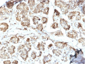 IHC staining of FFPE human breast carcinoma with NME2 antibody. HIER: boil tissue sections in pH6, 1