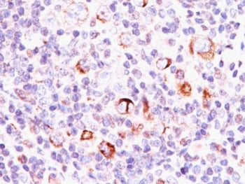 IHC: Formalin-fixed, paraffin-embedded human Hodgkin's lymphoma stained with Bcl-X antibody (SPM337)
