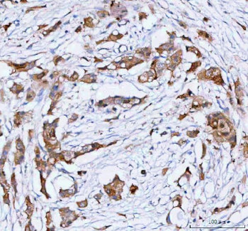 IHC analysis of PHGDH using anti-PHGDH antibody. PHGDH was detected in a paraffin-embedded section o