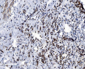 IHC staining of FFPE human breast cancer with VDAC3 antibody. HIER: boil tissue sections in pH8 EDTA