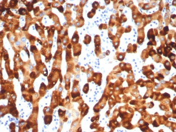 IHC staining of FFPE human HBV-infected liver with HBsAg antibody (clone HBsAG/7666R). HIER: boil ti