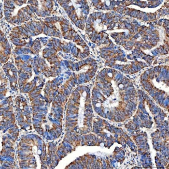 IHC staining of FFPE human rectum adenocarcinoma tissue with SERAC1 antibody. HIER: boil tissue sect