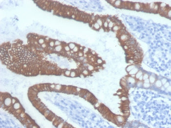 IHC staining of FFPE human colon carcinoma with Cytokeratin 20 antibody (clone KRT20/3145). HIER: bo