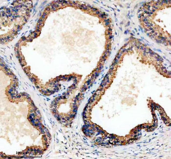 Immunohistochemical staining of TPD52 using anti-TPD52 antibody. TPD52 was detected in a paraffin-em