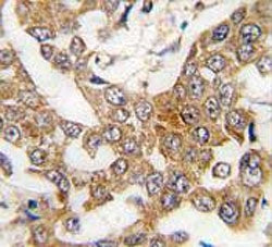 IHC testing of FFPE human breast cancer tissue with Bcl-W antibody. HIER: steam section in pH6 citra