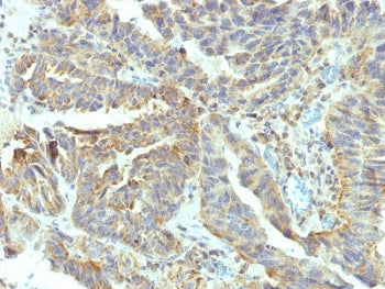 IHC testing of FFPE human ovarian carcinoma with ALPL antibody (clone V17.1). Required HIER: boil ti