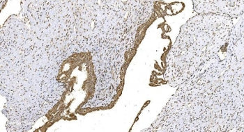 IHC staining of FFPE human breast carcinoma with Wee1 antibody. HIER: boil tissue sections in pH 8 E