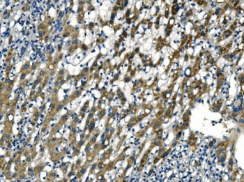 IHC staining of FFPE human liver cancer tissue with APLN antibody. HIER: boil tissue sections in pH8