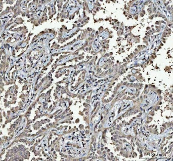 IHC staining of FFPE human lung cancer tissue with RTCB antibody. HIER: boil tissue sections in pH8
