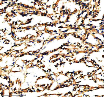 Immunohistochemical staining of PXDN using anti-PXDN antibody. PXDN was detected in a paraffin-embed
