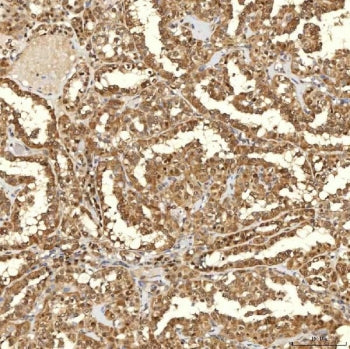 IHC staining of FFPE human thyroid cancer tissue with FAM60A antibody. HIER: boil tissue sections in