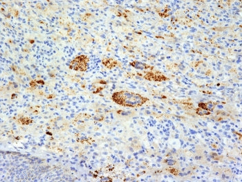 IHC: Formalin-fixed, paraffin-embedded human Erdheim Chester disease (also known as polyostotic lero
