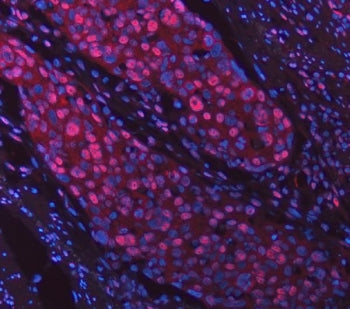 Immunofluorescent staining of FFPE human squamous carcinoma tissue with Sm-D2 antibody (red) and DAP