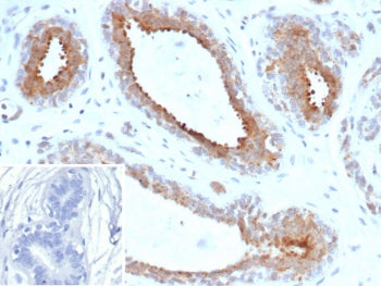 IHC staining of FFPE human breast carcinoma tissue with BAP1 antibody (clone BAP1/13501R). Inset: PB