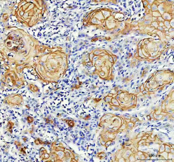 IHC analysis of LY6D using anti-LY6D antibody. LY6D was detected in a paraffin-embedded section of h