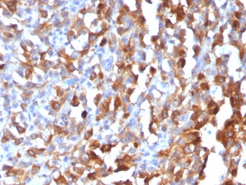 IHC testing of formalin-fixed, paraffin-embedded human melanoma stained with recombinant MART-1 anti