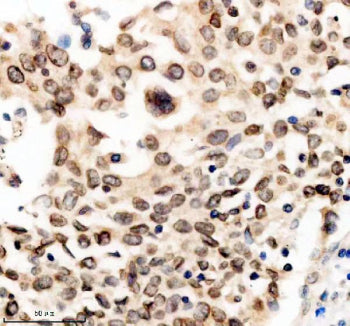 Immunohistochemical staining of TMPO using anti-TMPO antibody. TMPO was detected in a paraffin-embed