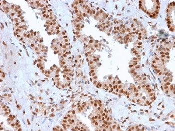 IHC testing of FFPE human prostate carcinoma with APE1 antibody (clone CPTC-APEX1-2). Required HIER: