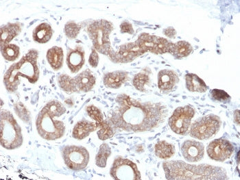 IHC staining of FFPE human breast carcinoma with Calpain antibody (clone CAPN1/1530). HIER: boil tis