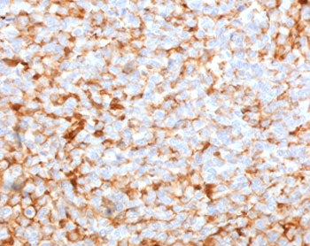 IHC testing of FFPE human breast carcinoma stained with recombinant Mammaglobin A antibody (clone MM