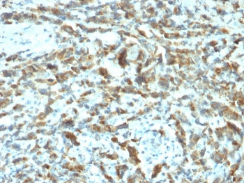 IHC staining of FFPE human breast carcinoma with pS2 antibody (clone TFF1/2133). HIER: boil tissue s