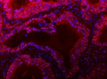 Immunofluorescent staining of FFPE human colon cancer tissue with TIGD1 antibody (red) and DAPI nucl