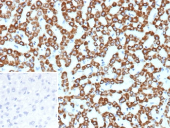 IHC staining of FFPE human hepatocellular carcinoma tissue with CPS1 antibody (clone CPS1/9857). Ins