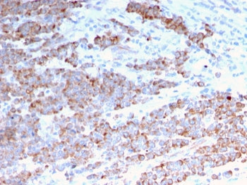 IHC staining of FFPE human colon carcinoma with recombinant Cytokeratin 18 antibody (clone rKRT18/11