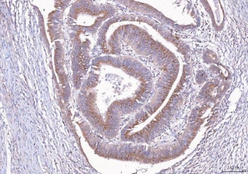 IHC staining of FFPE human rectal cancer tissue with ALDH3A1 antibody. HIER: boil tissue sections in