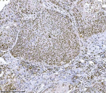 IHC staining of FFPE human squamous cell lung carcinoma tissue with JHDM3A antibody. HIER: boil tiss