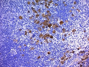 IHC: Formalin-fixed, paraffin-embedded human Hodgkin's lymphoma stained with CD30 antibody (Ber-H2 +