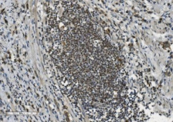 IHC staining of FFPE human poorly differentiated adenocarcinoma of the stomach with PARP antibody. H