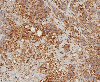 IHC staining of FFPE human bladder carcinoma with HLA-G antibody (clone HLAG/8344R). HIER: boil tiss