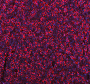 Immunofluorescent staining of FFPE human gastric cancer tissue with ME1 antibody (red) and DAPI nucl
