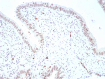 IHC staining of FFPE human ovarian carcinoma tissue with Paired box 4 antibody (clone PAX4/7599). HI