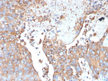 IHC staining of FFPE human urothelial carcinoma with Uroplakin 1B antibody. HIER: boil tissue sectio