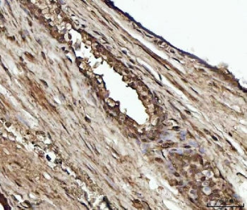 IHC staining of FFPE human prostate cancer tissue with YWHAE antibody. HIER: boil tissue sections in