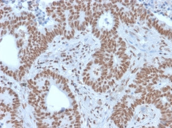 IHC staining of FFPE human colon carcinoma with NRF1 antibody. HIER: boil tissue sections in pH 9 10