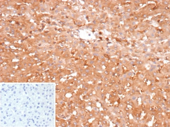 IHC staining of FFPE human hepatocellular carcinoma tissue with Glucose-6-phosphate isomerase antibo