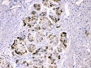 IHC testing of FFPE human liver cancer tissue with Fibrinogen gamma chain antibody at 1ug/ml. HIER: