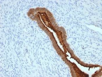 IHC: Formalin-fixed, paraffin-embedded human endometrial carcinoma stained with anti-MUC-1 antibody