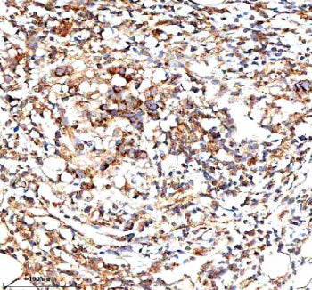 Immunohistochemical staining of IVNS1ABP using anti-IVNS1ABP antibody. IVNS1ABP was detected in a pa