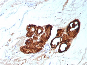 IHC staining of FFPE human breast carcinoma tissue with GCDFP-15 antibody (clone PIP/9076R). HIER: b