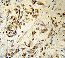 IHC testing of FFPE human breast carcinoma tissue with RBM3 antibody. HIER: steam section in pH6 cit