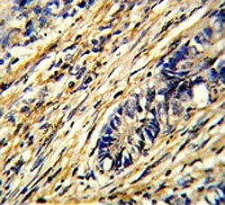IHC testing of FFPE human colon carcinoma tissue with YWHAG antibody. HIER: steam section in pH6 cit