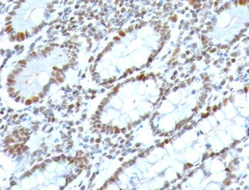 IHC testing of FFPE human colon carcinoma with BMI1 antibody (clone PGRF4-1). HIER: boil tissue sect