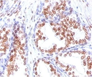 IHC: Formalin-fixed, paraffin-embedded human prostate carcinoma stained with Androgen Receptor antib