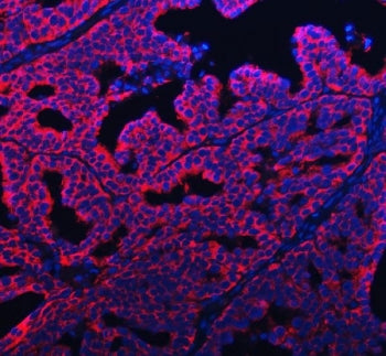 Immunofluorescent staining of FFPE human ovarian cancer tissue with APP-1 antibody (red) and DAPI nu